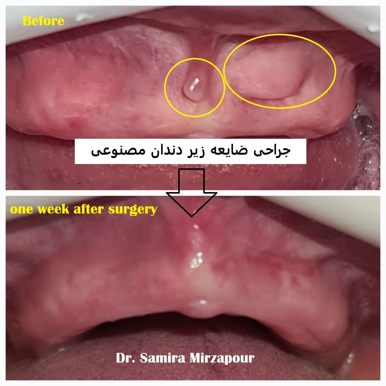 بیوپسی لثه (نمونه‌برداری بافت نرم) — تصویر بالینی