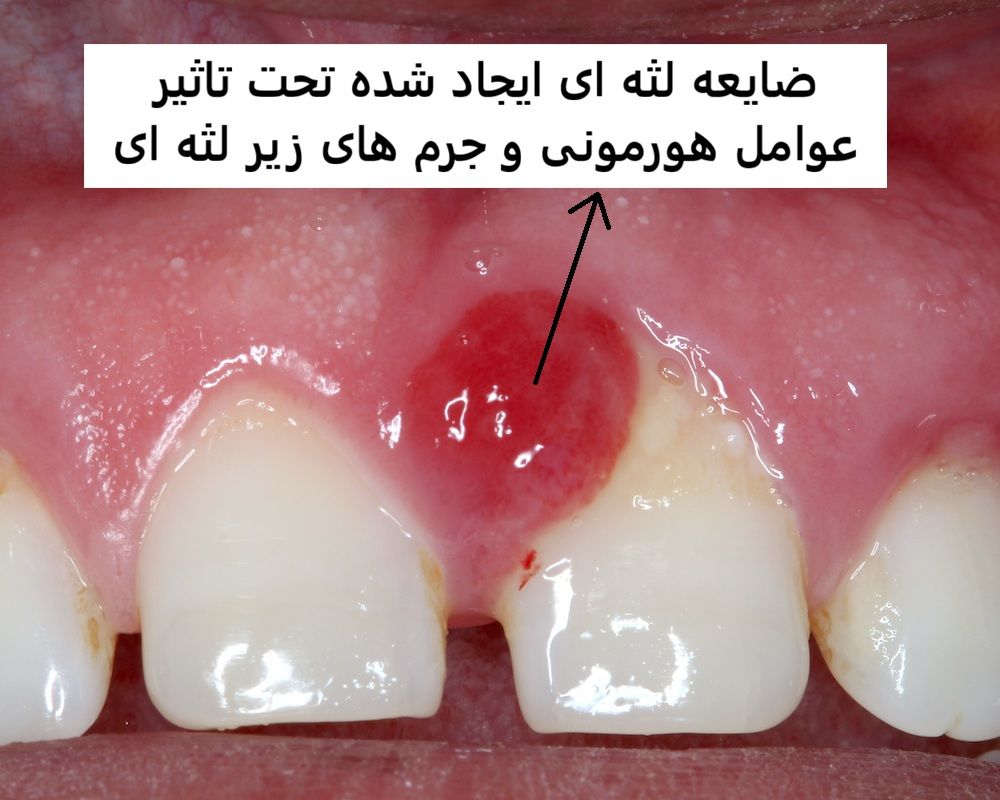 بیوپسی لثه (نمونه‌برداری بافت نرم)