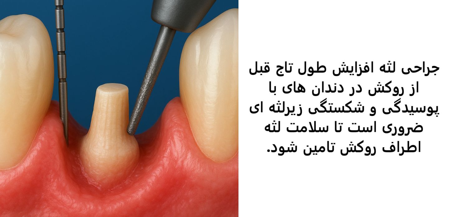 افزایش طول تاج بالینی — تصویر بالینی