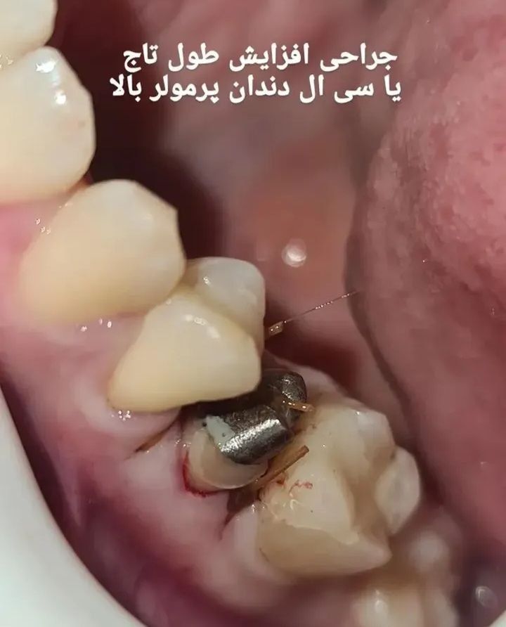افزایش طول تاج بالینی