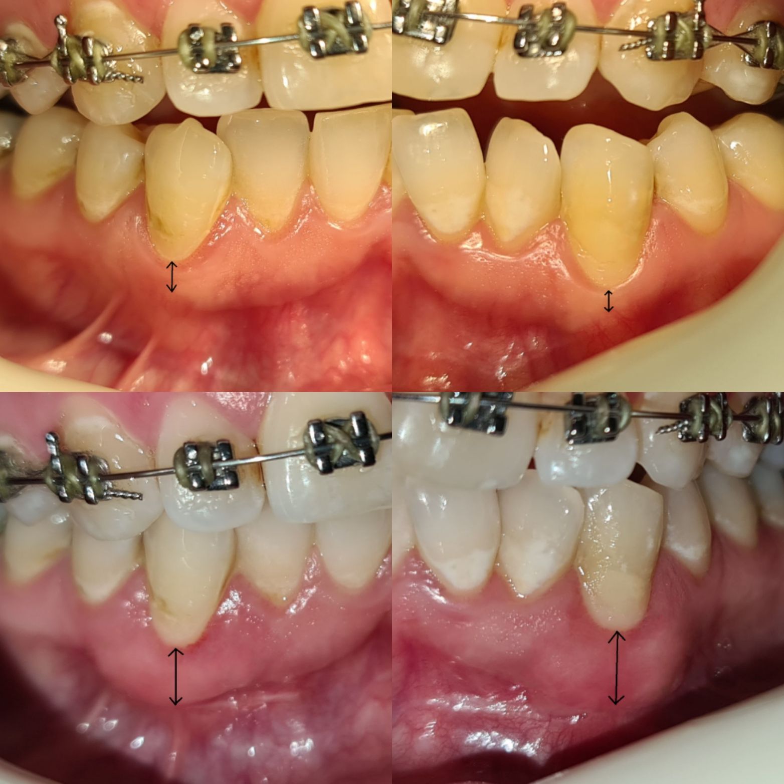 پیوند لثه — تصویر بالینی