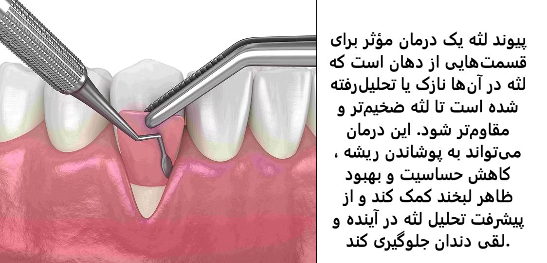 پیوند لثه — تصویر بالینی