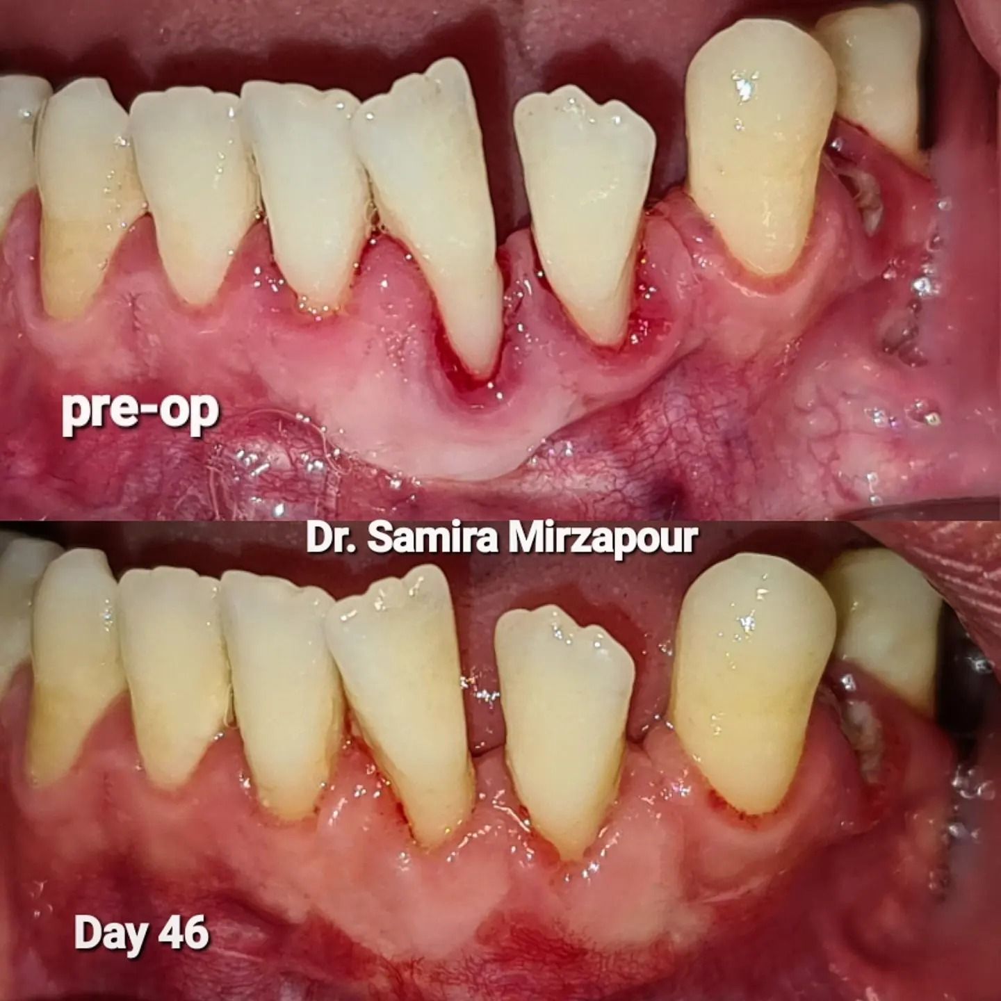 پیوند لثه — تصویر بالینی