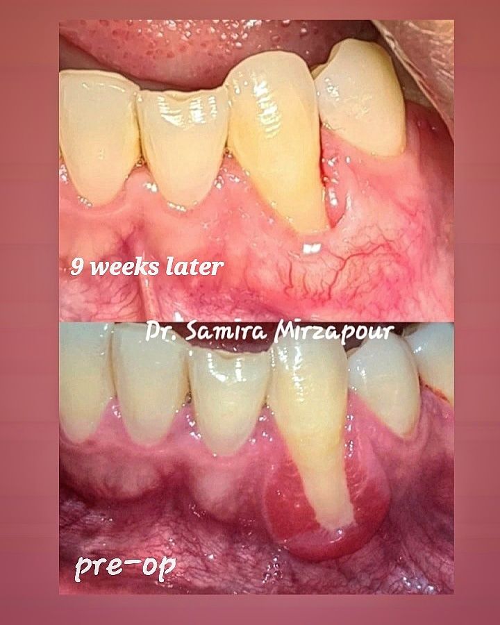 پیوند لثه — تصویر بالینی