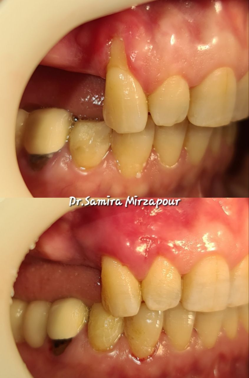 پیوند لثه — تصویر بالینی