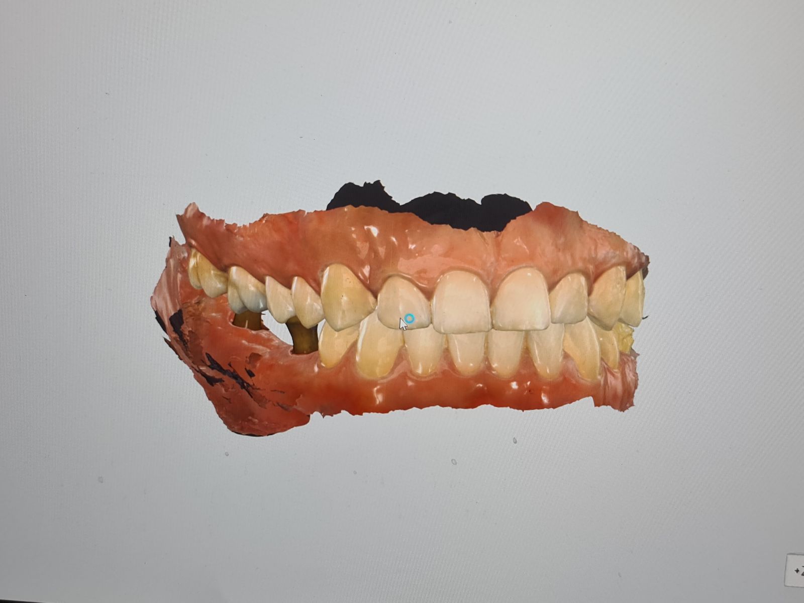 جراحی و جایگذاری ایمپلنت — تصویر بالینی