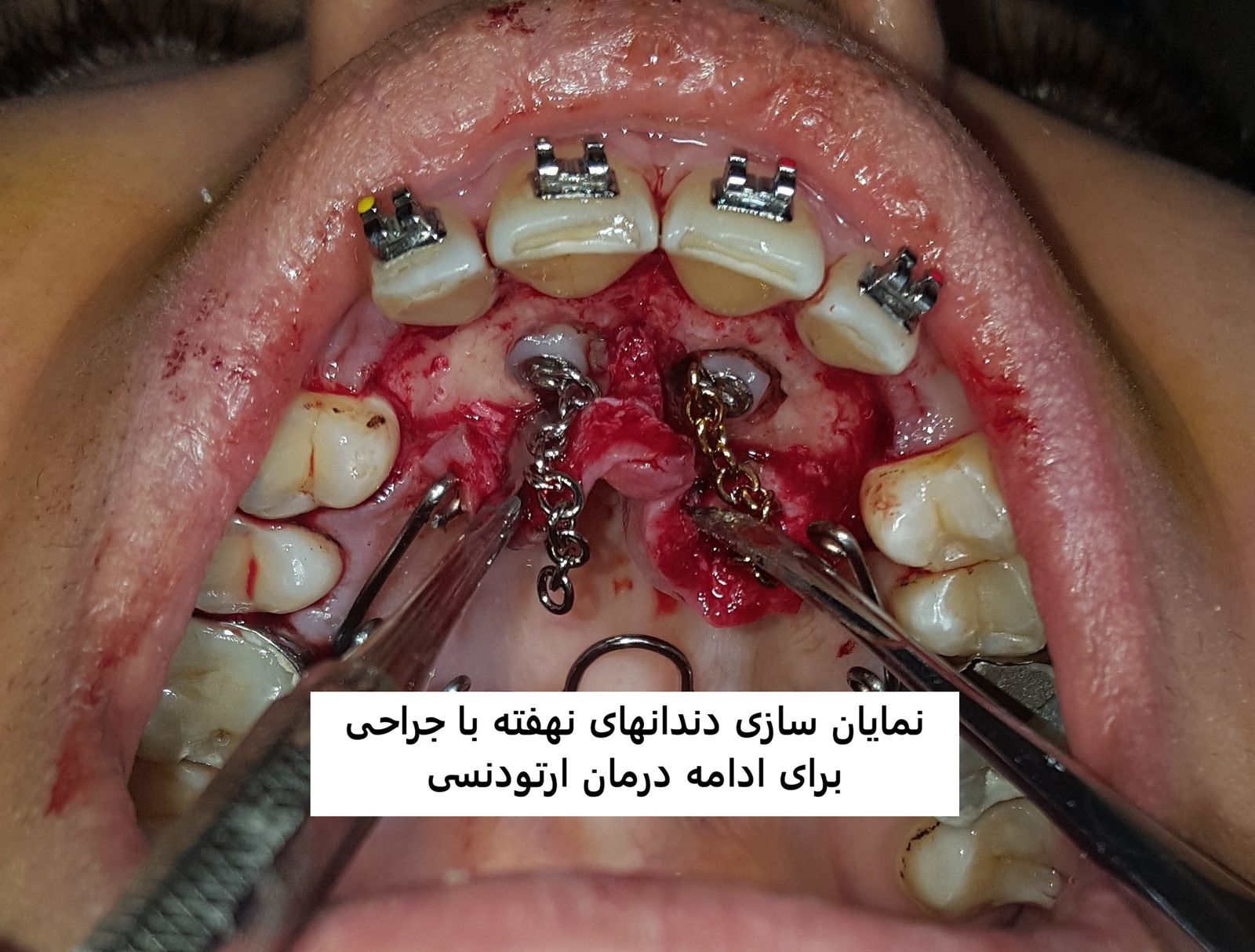 اکسپوژر جراحی دندان برای ارتودنسی